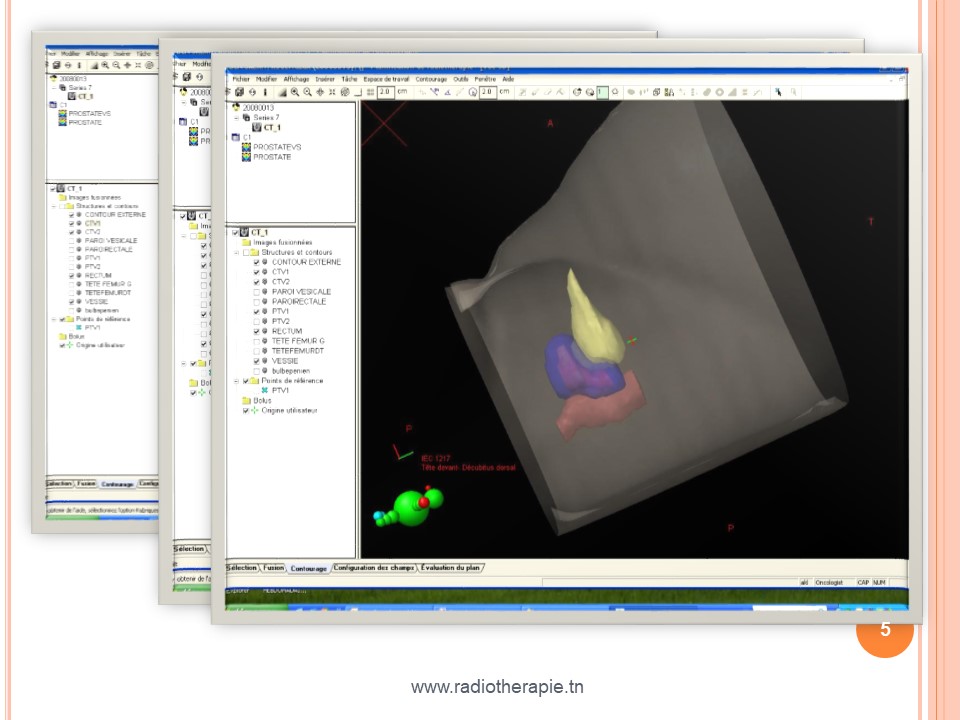 radiotherapie 3d 05