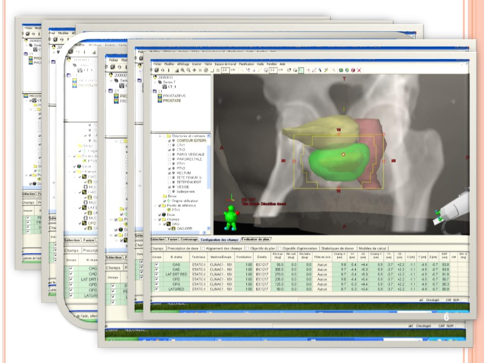 radiotherapie 3d 06