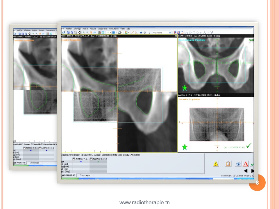 radiotherapie 3d 08